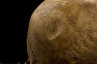 bladed weapon clipped skull, shaved off top layer of bone